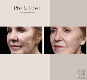 2 close-up photos of an older woman before and after she receives microneedling in Burlington.
